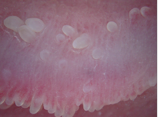 Couronne perlée du gland, ou encore papules perlées du gland, correspond à des petites élevures tout autour du gland.