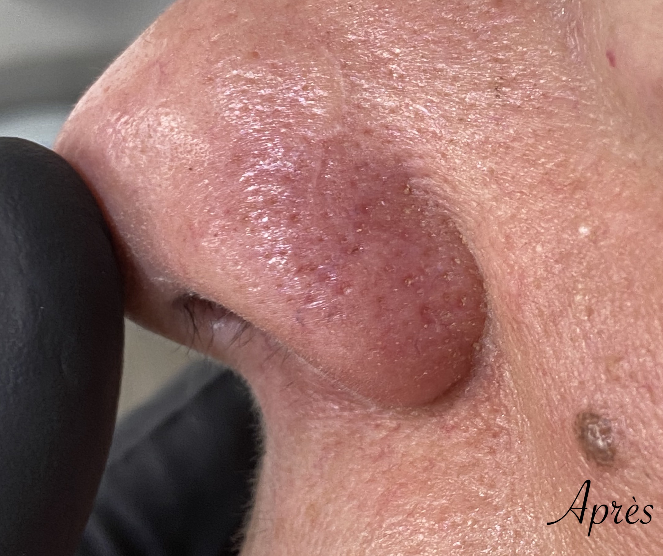 couperose aile du nez après traitement par laser vasculaire YAG, le GentleMax Pro (CANDELA)