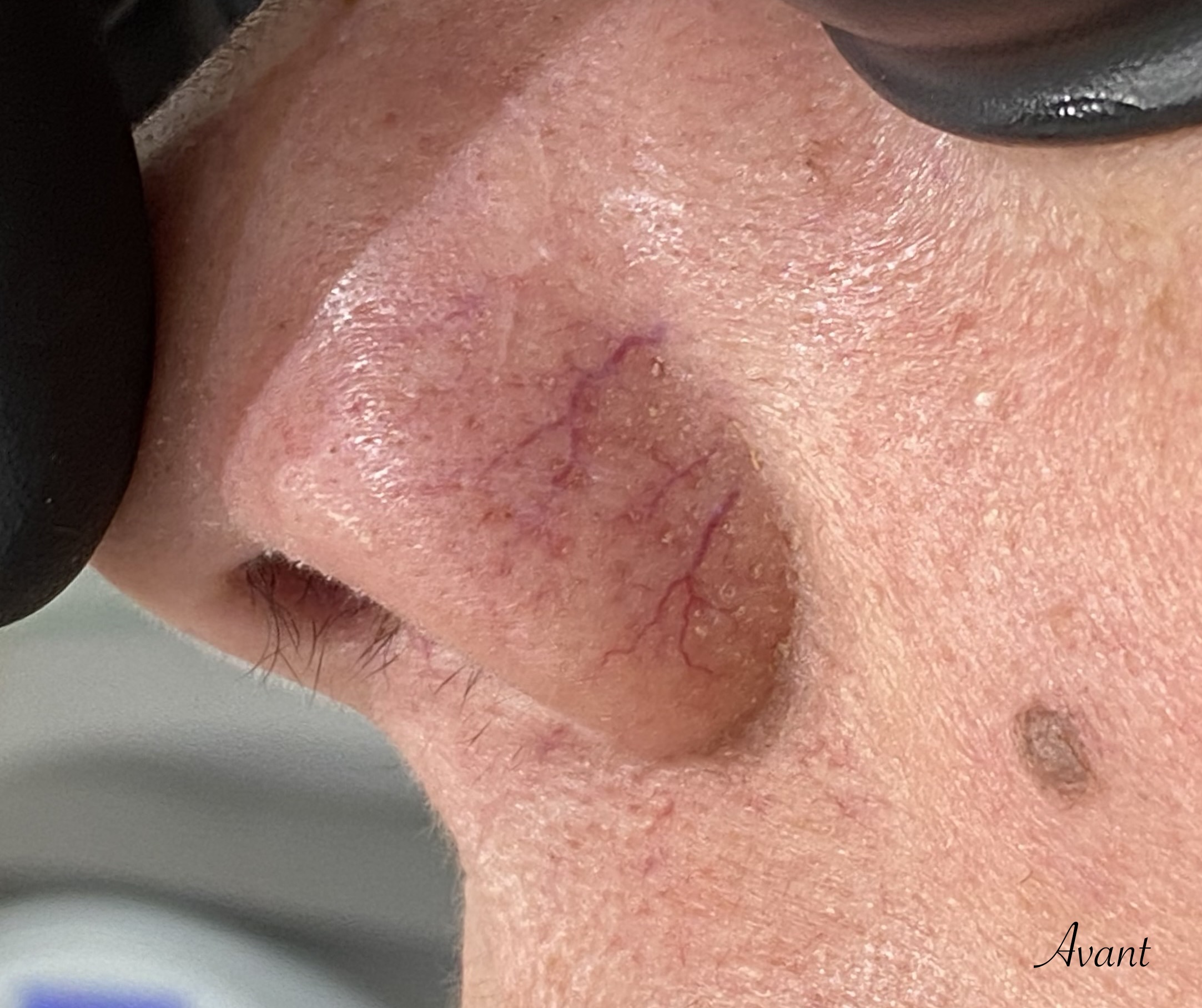 couperose aile du nez avant traitement par laser vasculaire YAG, le GentleMax Pro (CANDELA)