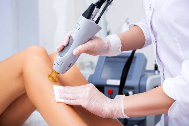 Epilation definitive laser YAG et Alexandrite