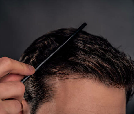 La greffe capillaire permet de greffer des cheveux, de la barbe ou encore des sourcils par la méthode de la FUE.