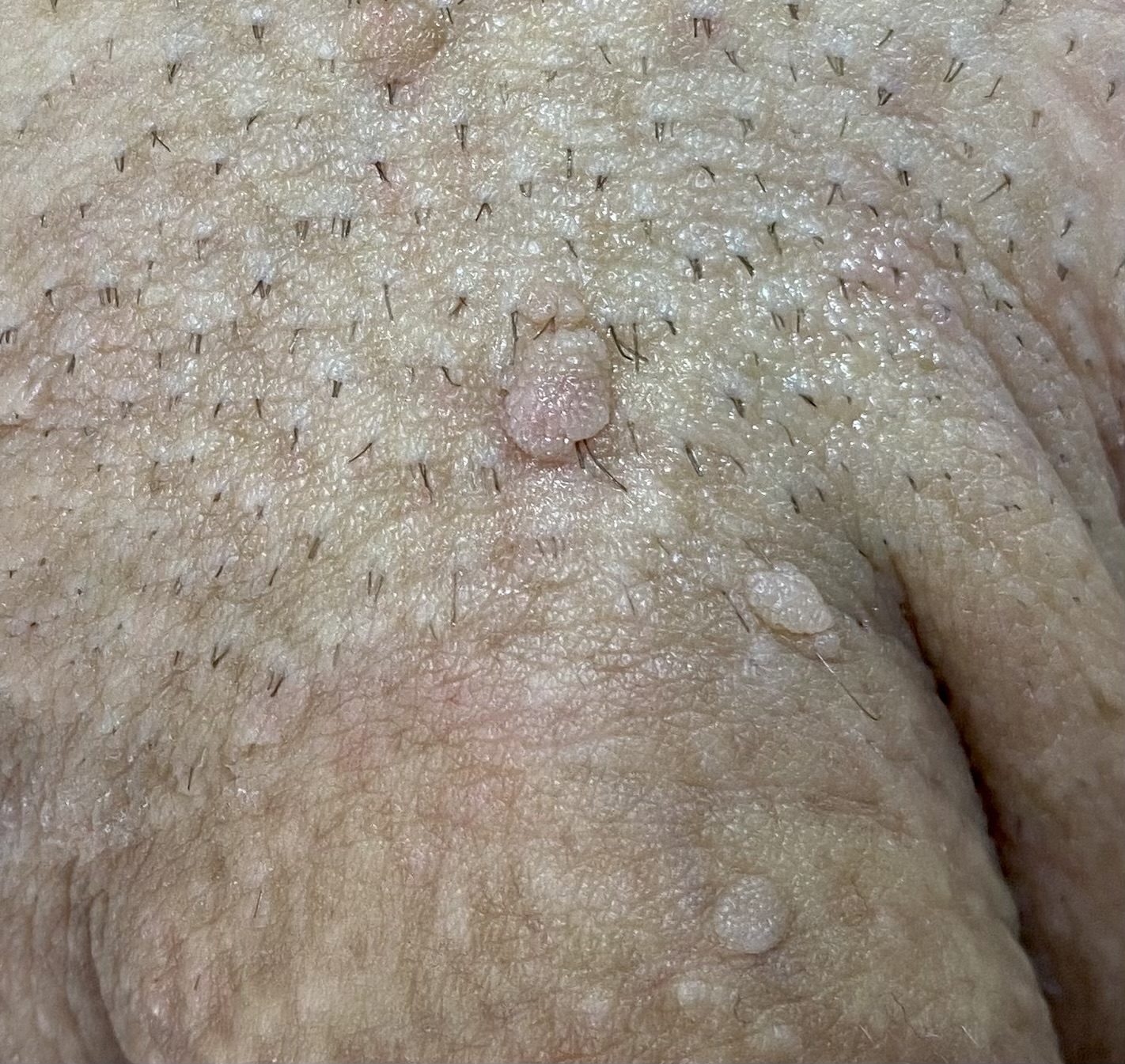 Condylomes verrues génitales chez l'homme – traitement PlexR® Dr Pierunek Paris 7