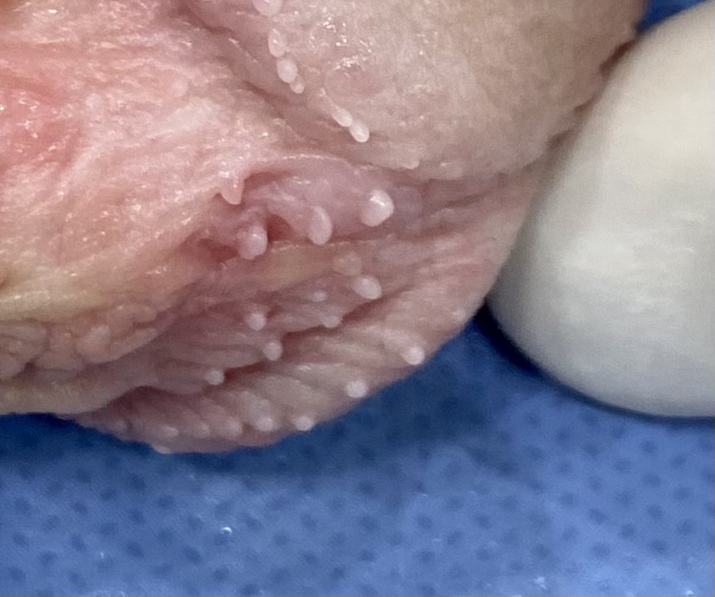 Couronne perlée du gland – traitement PlexR® Dr Pierunek Paris 7