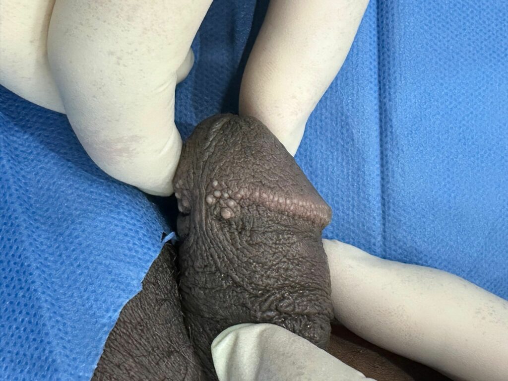 Couronne perlée chez l'homme avant traitement PlexR® – Dr Pierunek Paris 7