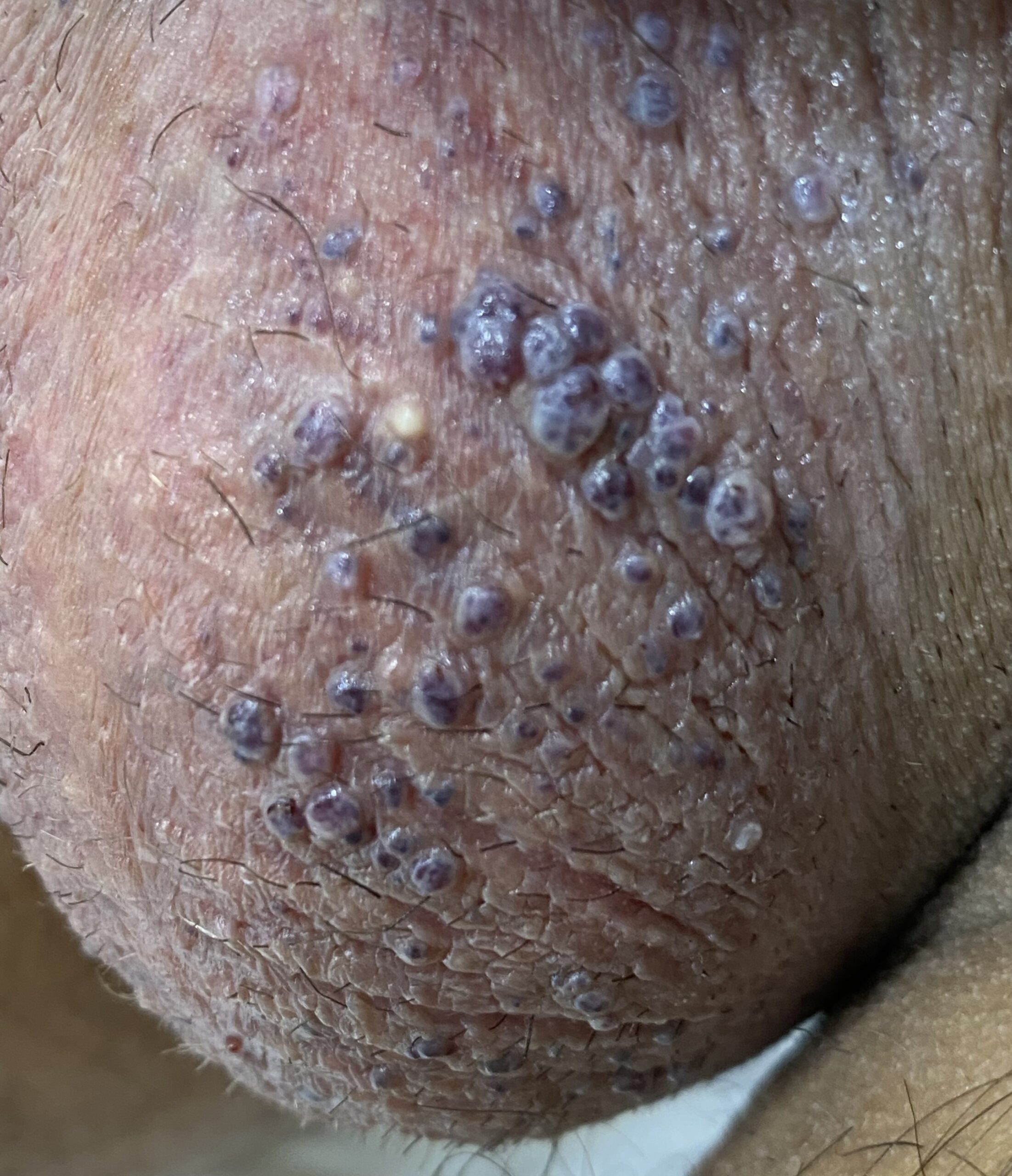 Traitement angiokératomes du scrotum – Dr Pierunek PlexR®