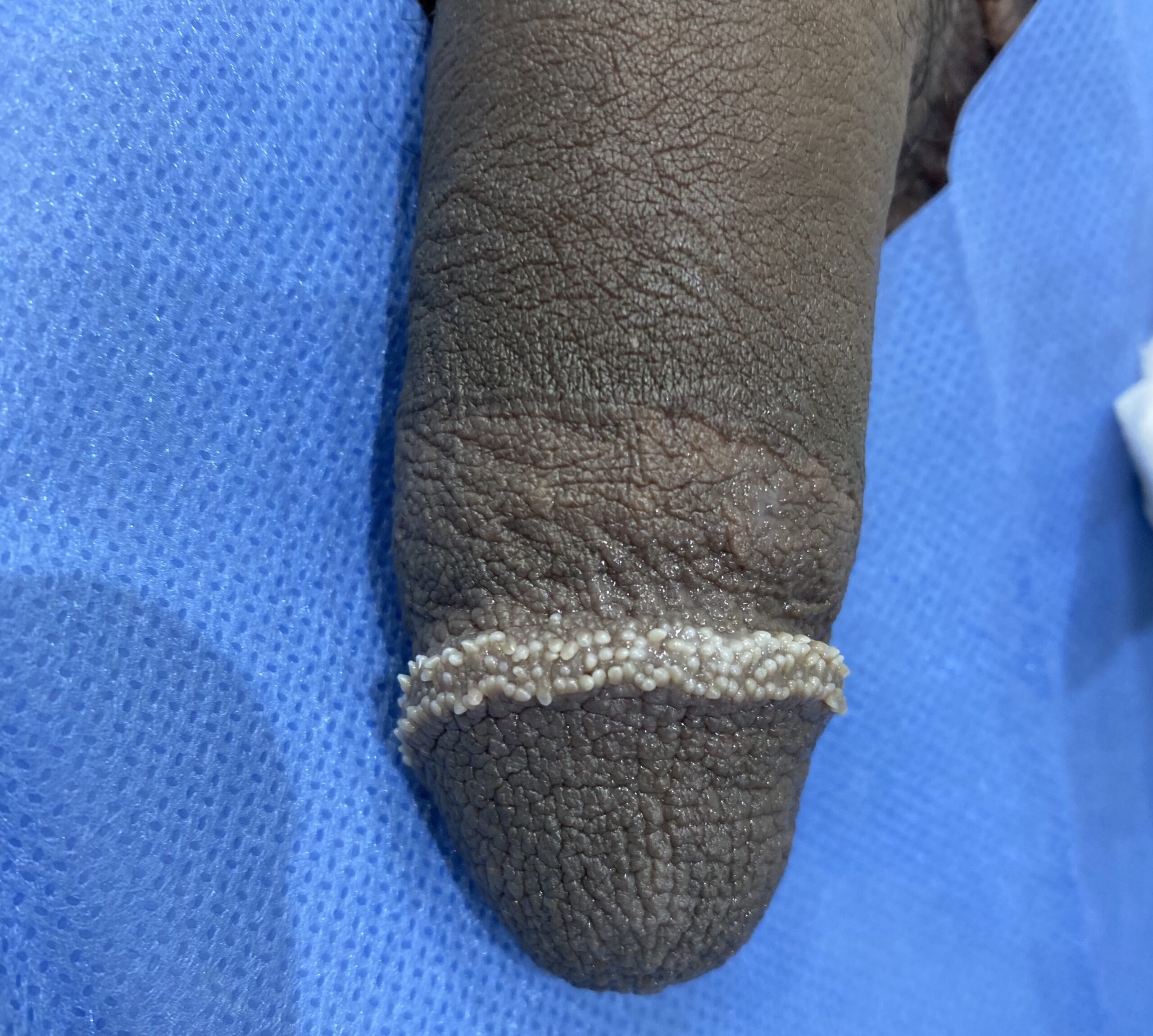 Petits boutons blancs sur le gland avant traitement PlexR® – Dr Pierunek Paris 7