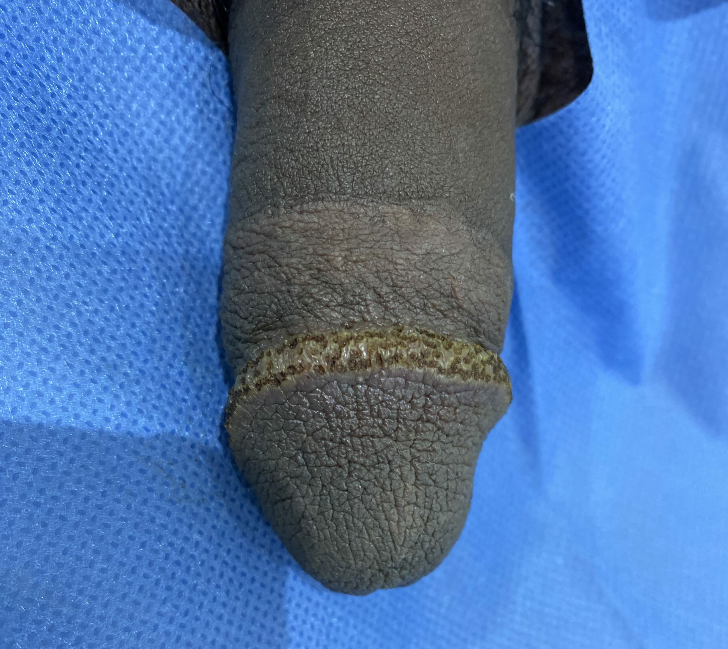 Couronne perlée juste après séance PlexR® – Dr Pierunek Paris 7