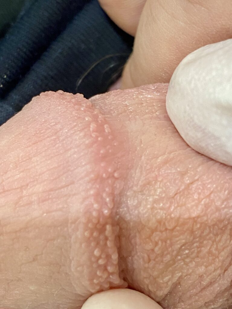 Traitement de couronne perlée du gland par PlexR sans chirurgie et sans aucune cicatrice par le Dr. PIERUNEK Tom