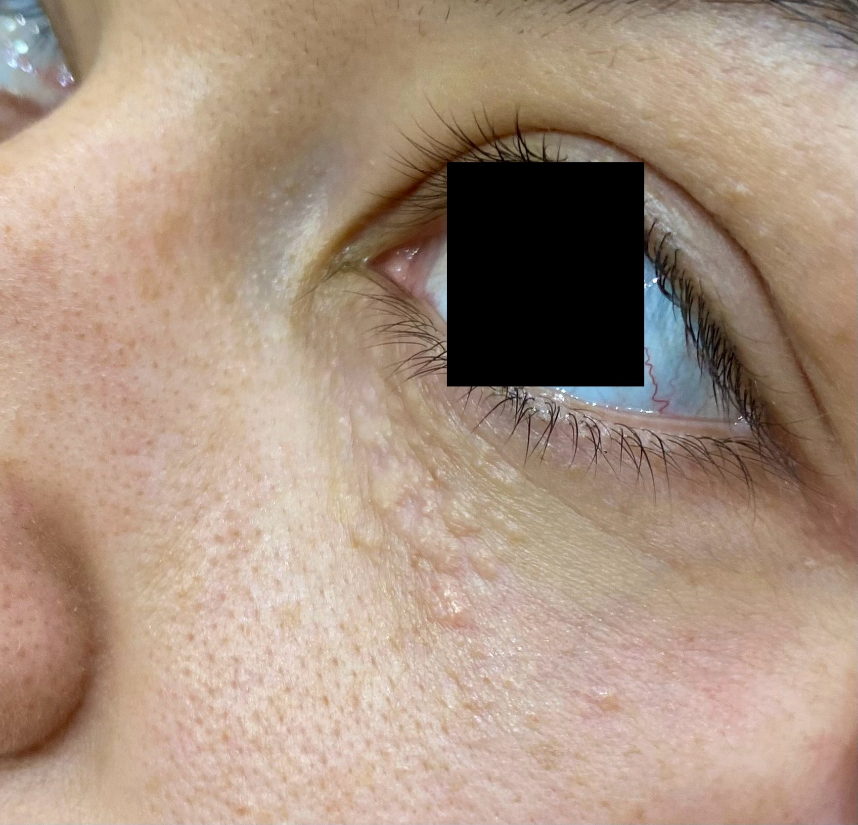 Traitement syringomes – Dr Pierunek PlexR®