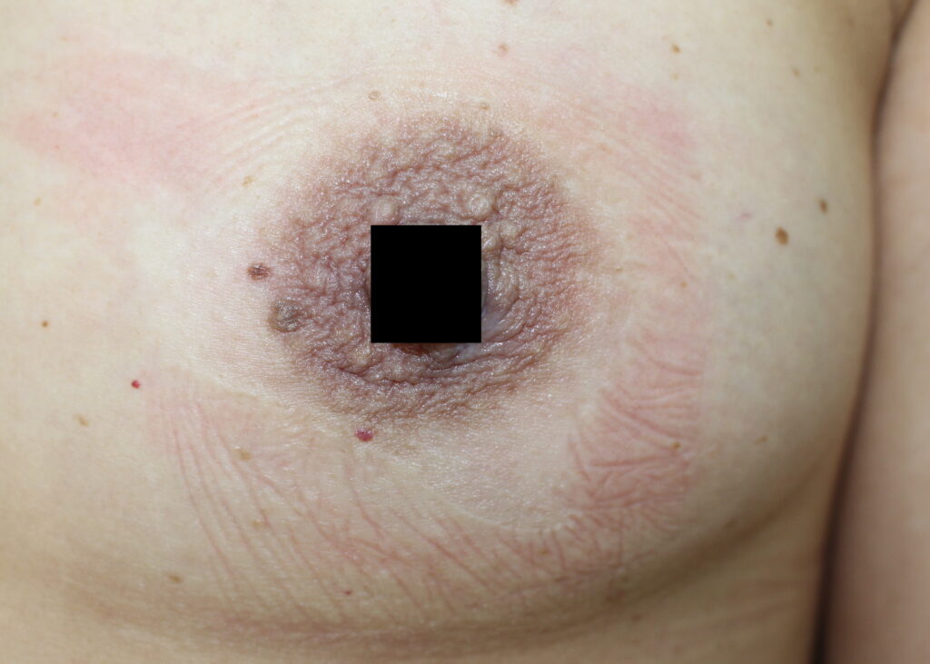 Traitement des tubercules de Montgomery par PlexR sans cicatrice.
