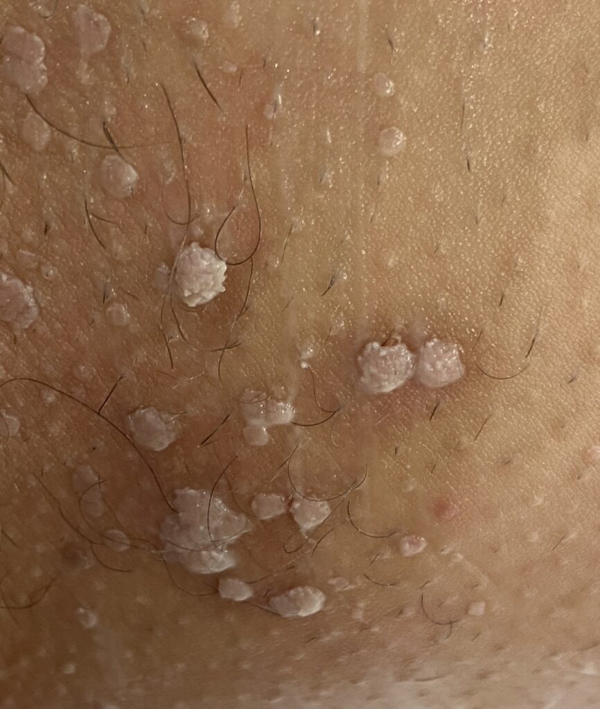 Verrues génitales appelées aussi condylomes traitées par PlexR par le Docteur PIERUNEK TOM