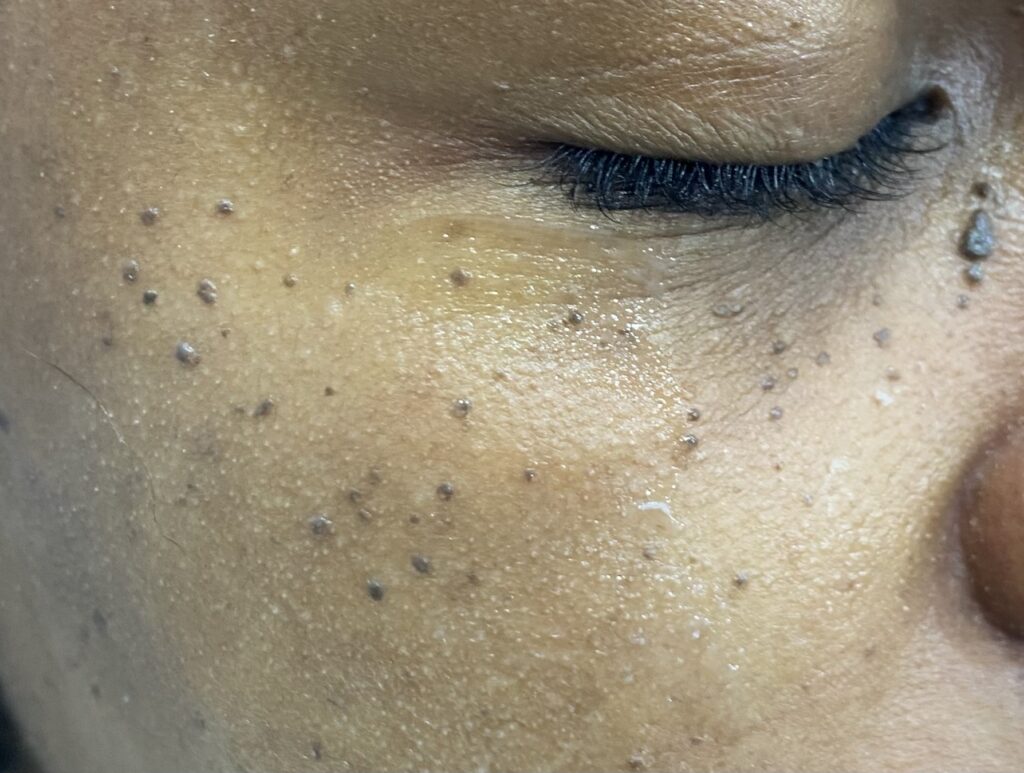 Dermatosis Papulosa Nigra – traitement PlexR® Dr Pierunek Paris 7