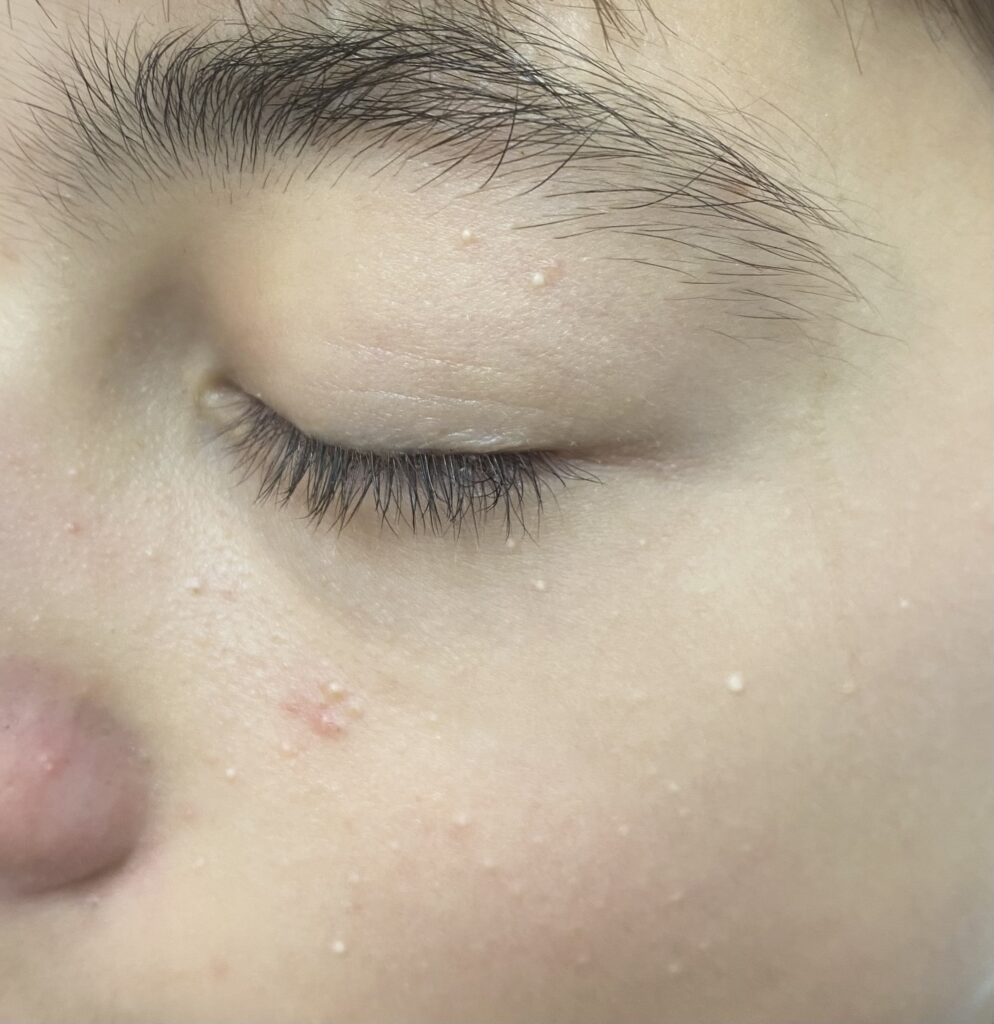 Grains de milium autour de l'œil – traitement PlexR® Dr Pierunek Paris 7