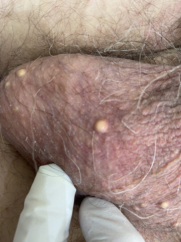 Hyperplasie des glandes sébacées du scrotum – Dr Pierunek Paris 7