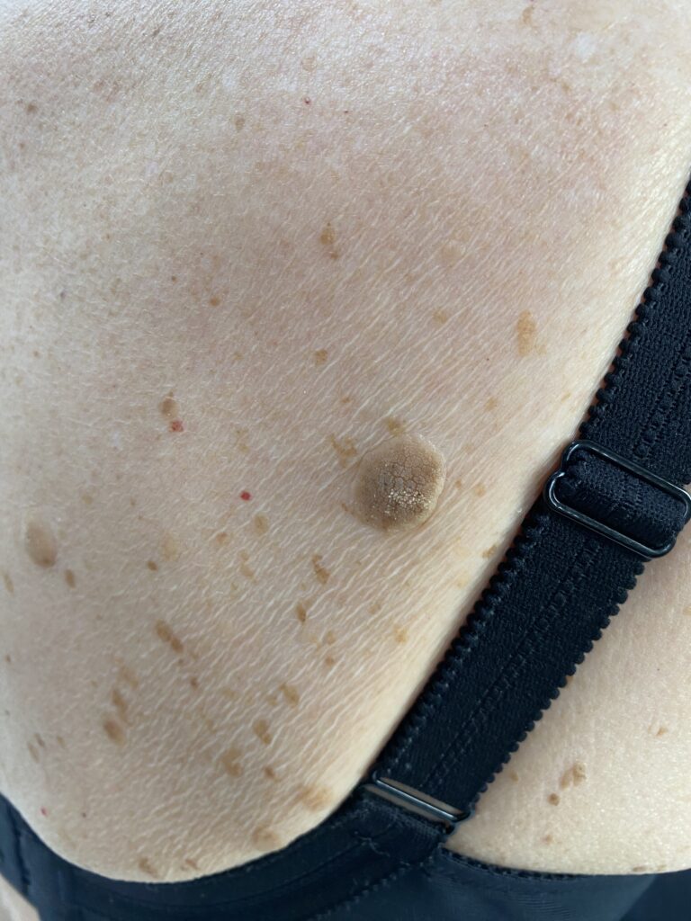 Kératose séborrhéique dans le dos – Dr Pierunek Paris 7