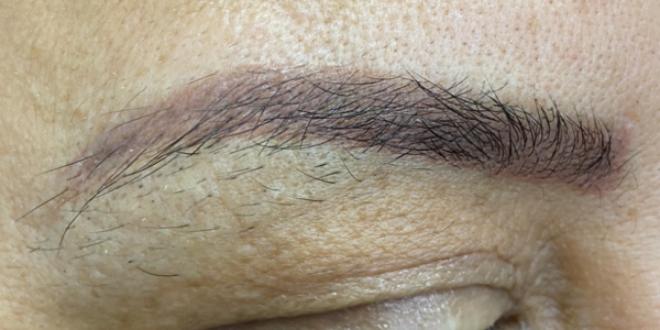 détatouage des sourcils, sourcils de couleur rouge violet avant traitement par laser picoseconde, le PicoWay de CANDELA