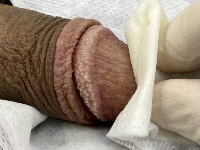 Couronne perlée du gland, correspondant à des papules perlées, traitée par PlexR.