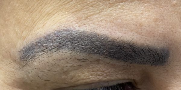 détatouage des sourcils, sourcils de couleur rouge violet qui a eu un virage pigmentaire noir après traitement par laser picoseconde, le PicoWay de CANDELA